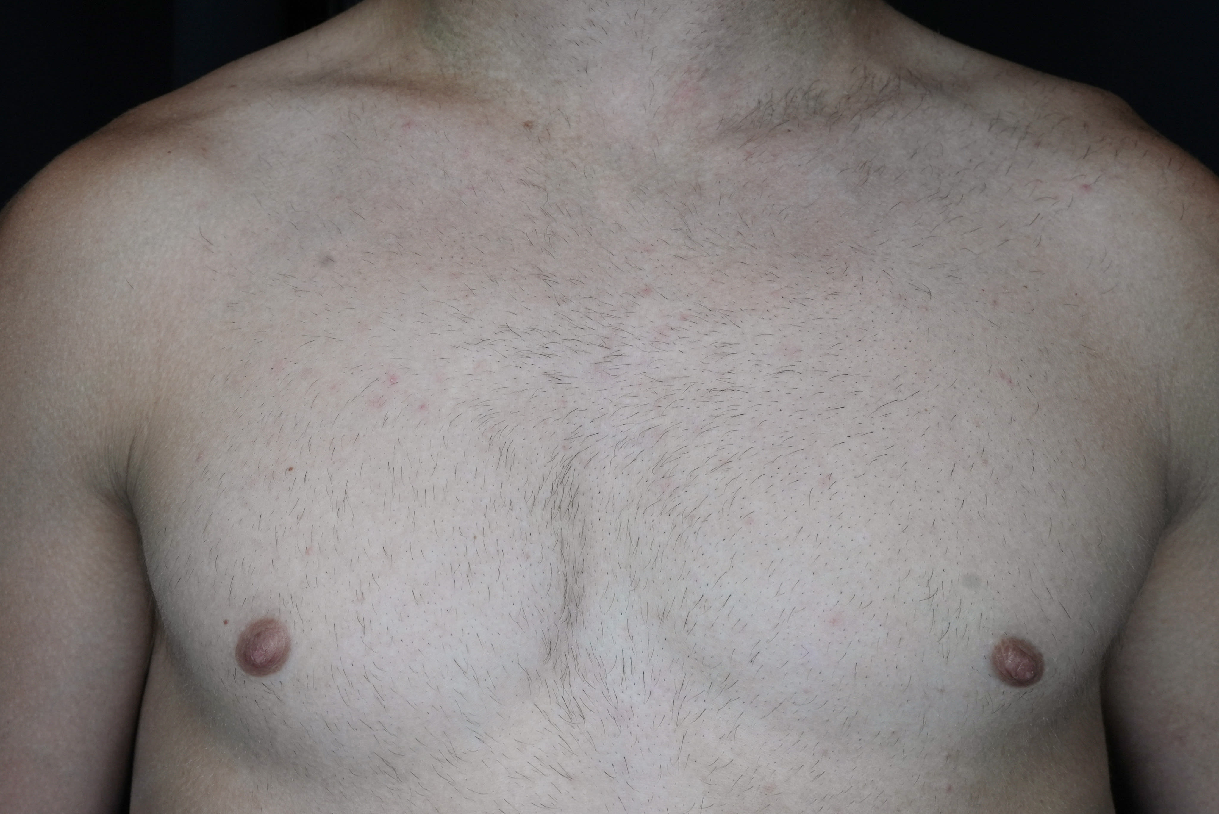Laser hair removal chest after one session